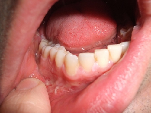 هل فطريات الفم خطيره ؟ وما هي أسبابها وطرق علاجها ؟