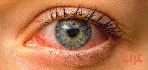 تفسير رؤية مرض العين في المنام
